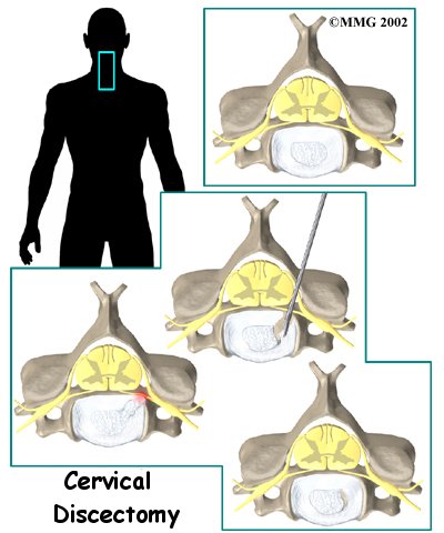 Cervical Discectomy
